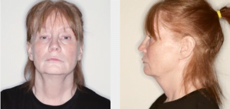 شد ترهلات الرقبة بدون جراحة