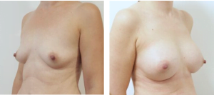 افضل دكتور تصغير الثدي في مصر