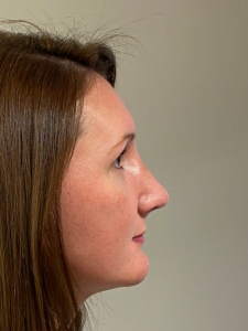 اسعار عمليات تجميل الانف في مصر