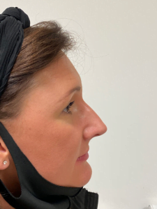 اسعار عمليات تجميل الانف في مصر