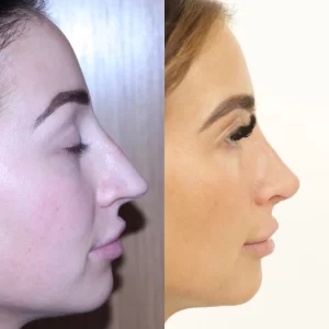 اسعار عمليات تجميل الانف في مصر