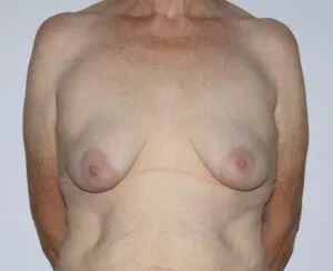 before-breast-augmentation-surgery-300x244