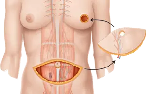 تجربتي مع ترميم الثدي
