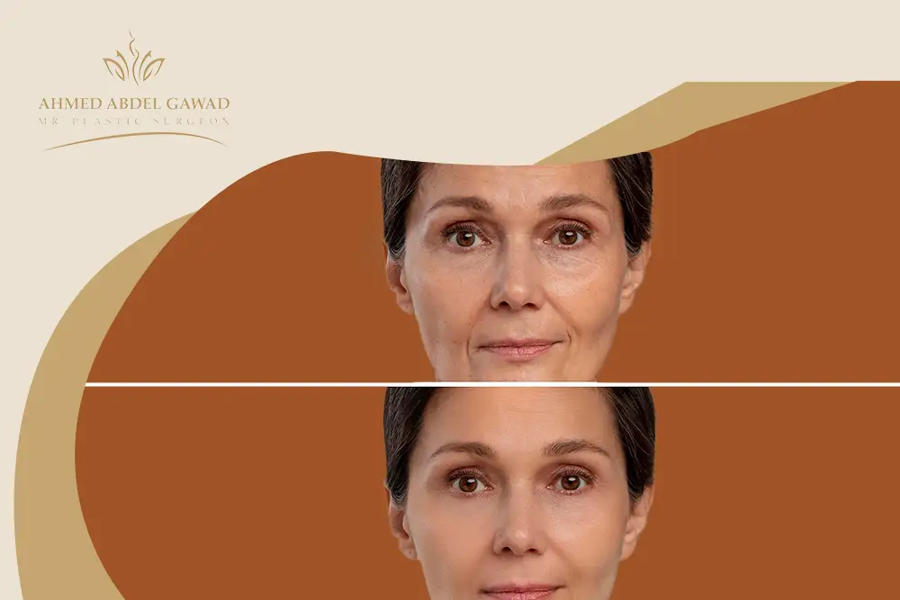 عملية شد الجفون قبل وبعد