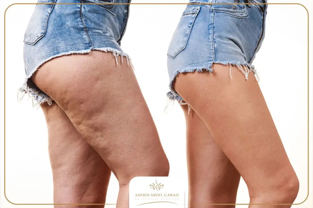 الوذمة الشحمية