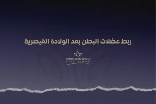 ربط عضلات البطن بعد الولادة القيصرية