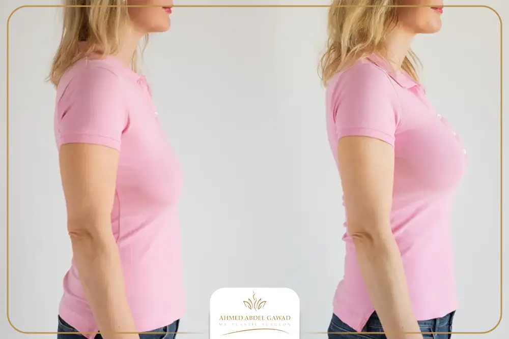 عمليات شد الثدي قبل وبعد